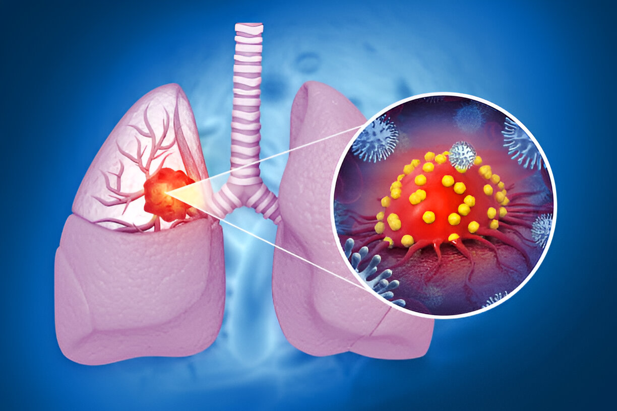 Best Interstitial Lung Disease & Lung Fibrosis treatment in South Mumbai